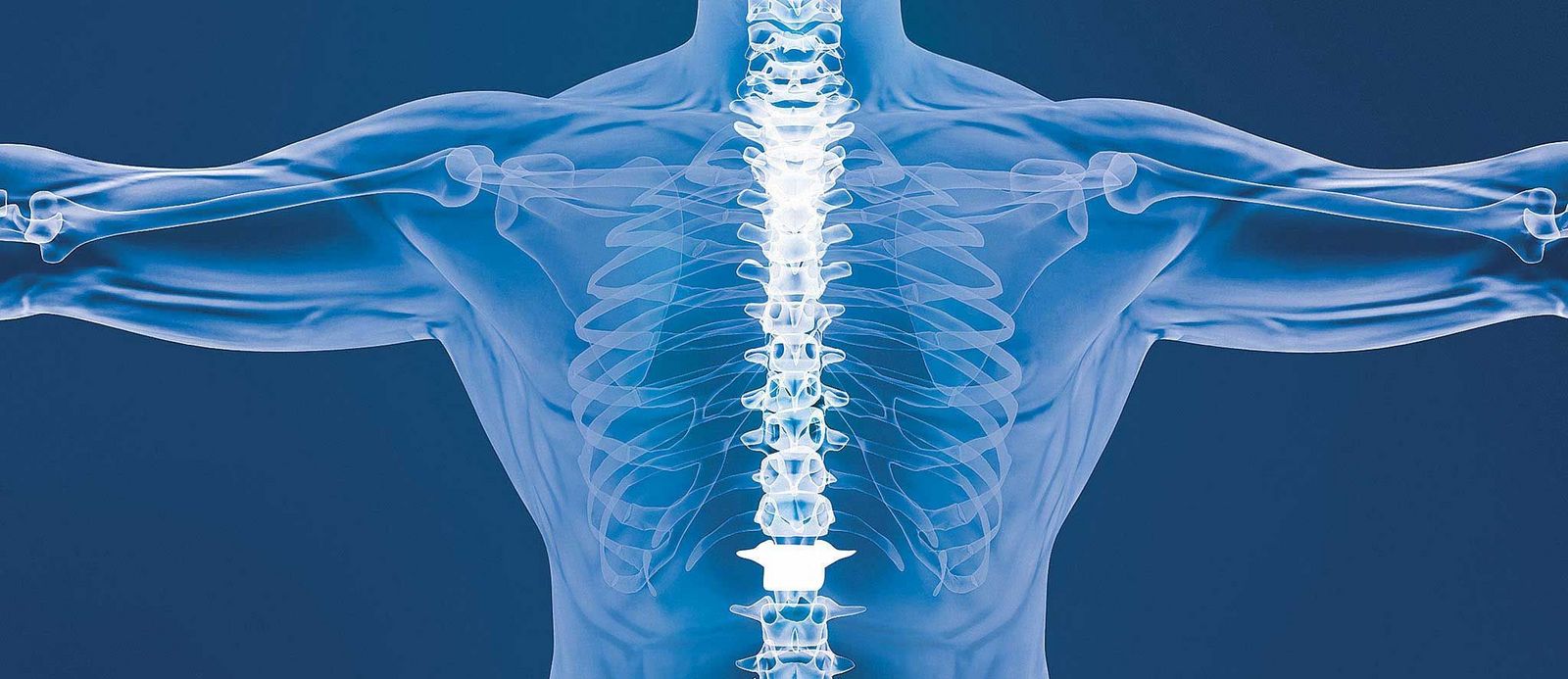 Spinal implant in the human body. Anatomy of human upper body in blue x-ray highlighting the spinal implant.