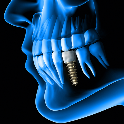 Innovative cutting fluids and their key role in making medical implants Innovative cutting fluids and their key role in making medical implants
