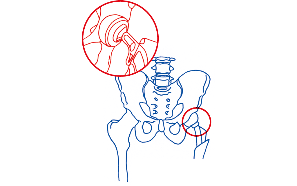 Sketch of knee and hip implants showing the application of lubricants.