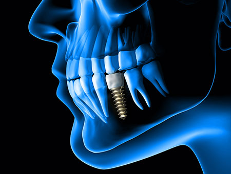Dental implant. Anatomy of human jaw in blue x-ray highlighting the dental implant.